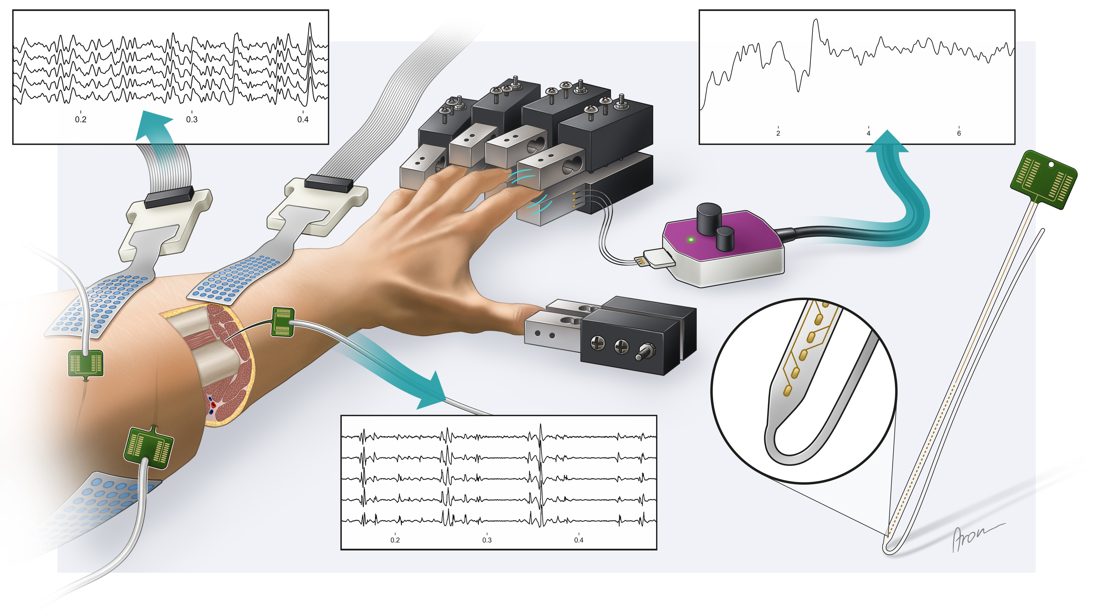 Illustration of a hand and forearm with surface and implanted electrodes, sensor hardware, and recordings of muscle activity